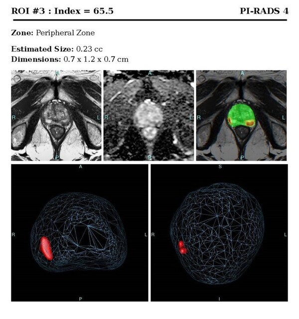 Prostate Cancer Detection Software ProstatID